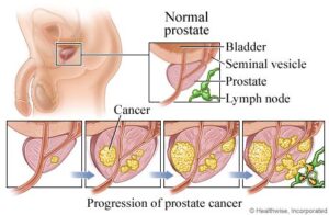 Prostate